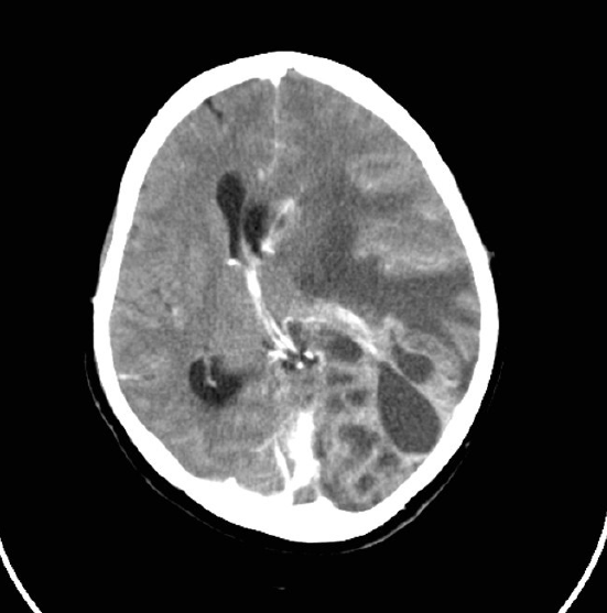 CT Brain of patient on presentation: shows massive left sided ruptured abscess with mid-line shift.